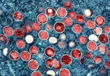 Wzrost zachorowań na Mpox w Niemczech: Berlin notuje najwyższą tygodniową liczbę infekcji