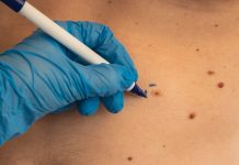 Niemcy: Liczba diagnoz raka skóry gwałtownie rośnie