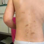 Siniaki na plecach chłopca z przedszkola