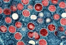 Niemcy: Czteroletnia dziewczynka zarażona małpią ospą