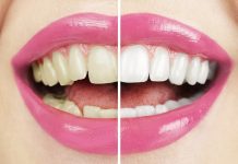 Wybielanie zębów w Niemczech – oto ile kosztuje u dentysty i jak zrobić to taniej!