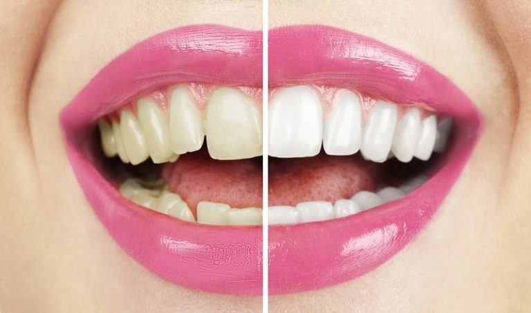 Wybielanie zębów w Niemczech – oto ile kosztuje u dentysty i jak zrobić to taniej!